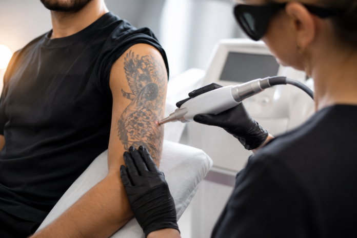 How many tattoo removal sessions
